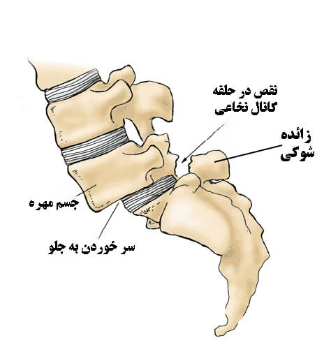 لغزندگی مهره کمری یا سرخوردگی مهره کمری