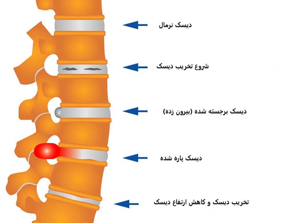 پارگی و بیرون زدگی و فتق دیسک