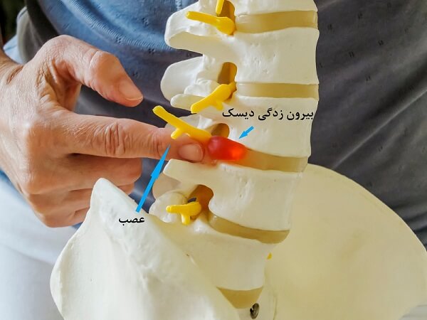 فتق دیسک کمر