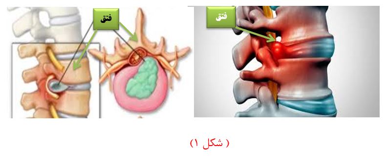 دیسک بین مهره