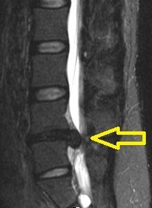 تصویر بیرون زدگی (فتق) دیسک کمر در MRI